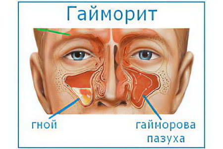 гайморит