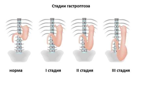 Стадии гастроптоза