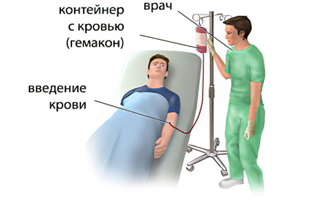 Что такое гемотрансфузия