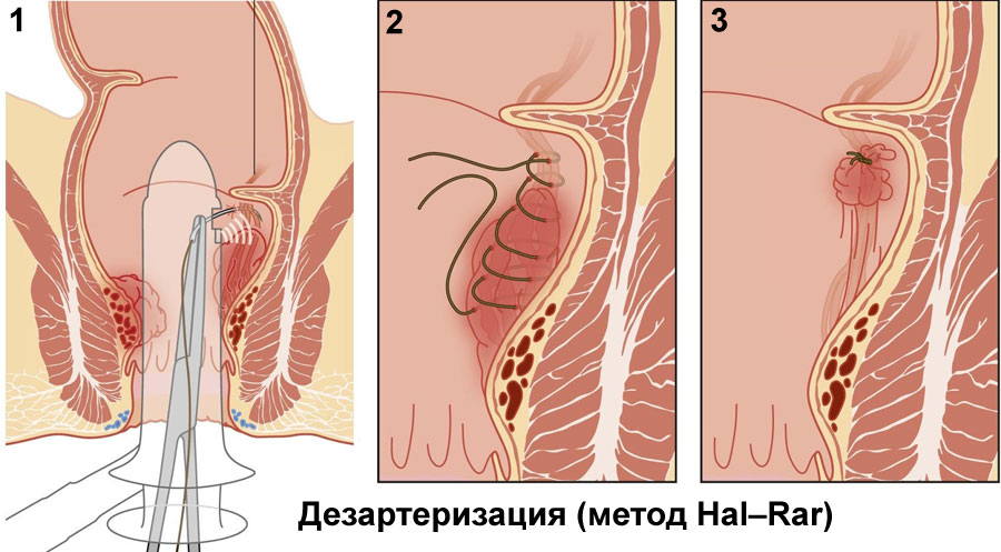 Дезартеризация (метод Hal–Rar)