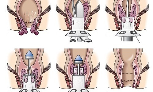 Операционное лечение геморроя