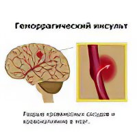 Капли первая помощь при инсульте