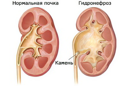 гидронефроз