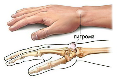 Гигрома