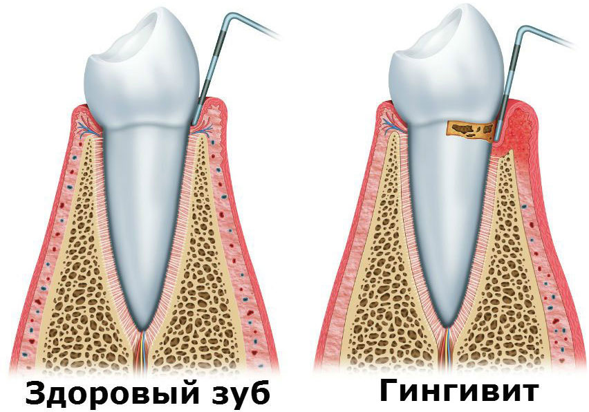 Гингивит Гингивит