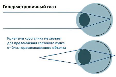 Дальнозоркость гиперметропия: причины, симптомы и лечение у взрослых и детей