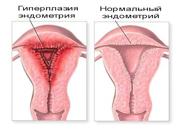 гиперплазия эндометрия гиперплазия эндометрия