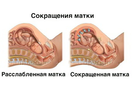 Гипертонус матки