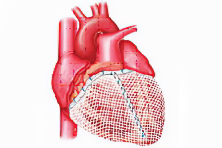 гипертрофия миокарда желудочка сердца