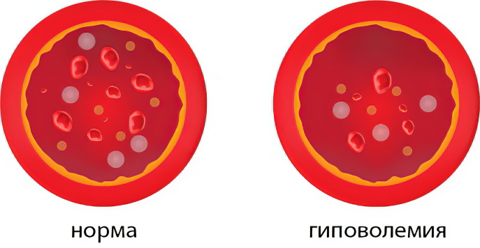 Гиповолемия