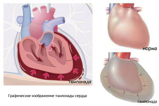 Осложнения перикардита