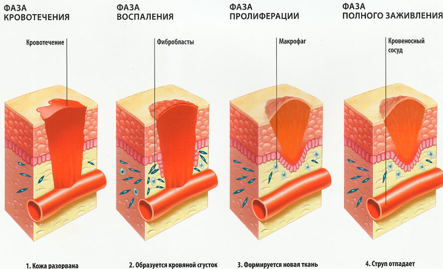 Грануляционное восстановление тканей