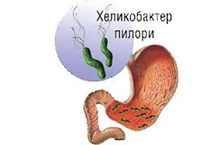 Helicobacter pylori