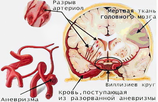 инсульт