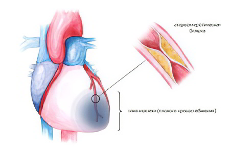 Ишемическая болезнь сердца