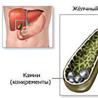 Избавление от камней в желчном пузыре отзывы