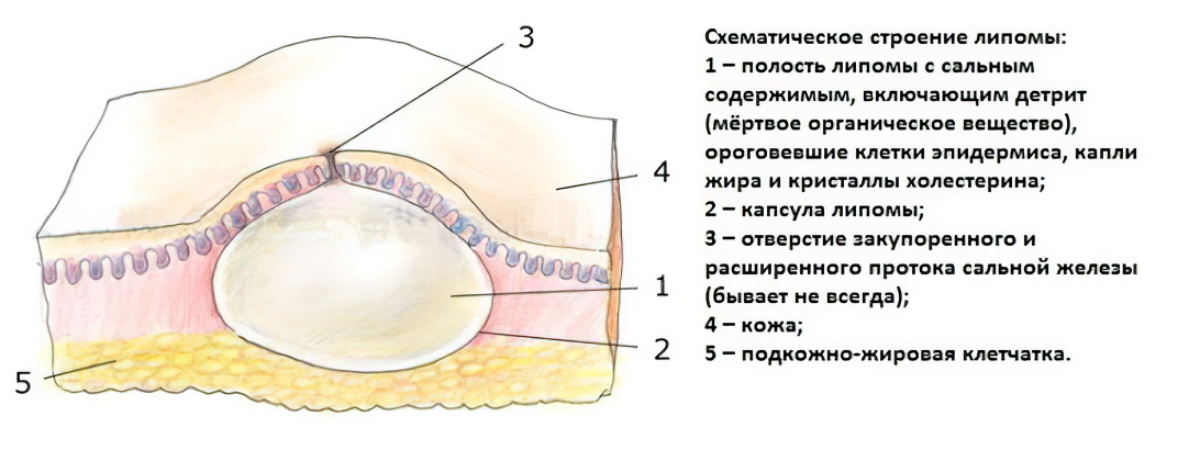 Мягкое тело заключено в. Липома жировой ткани кожи. Подкожно-жировая клетчатка липома. Жировик доброкачественная опухоль. Липома доброкачественная опухоль жировой ткани.