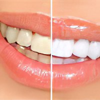 Чем снять воспаление и отек зуба