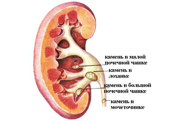 Камни в почках