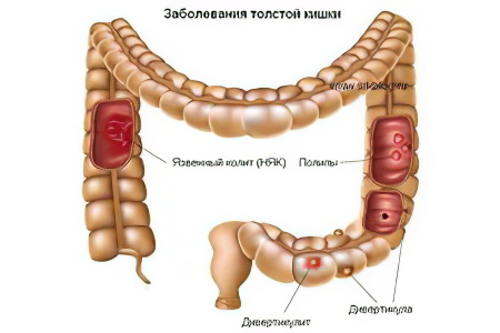 колит