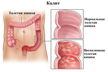 Колит