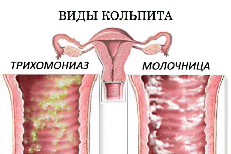 Кольпит