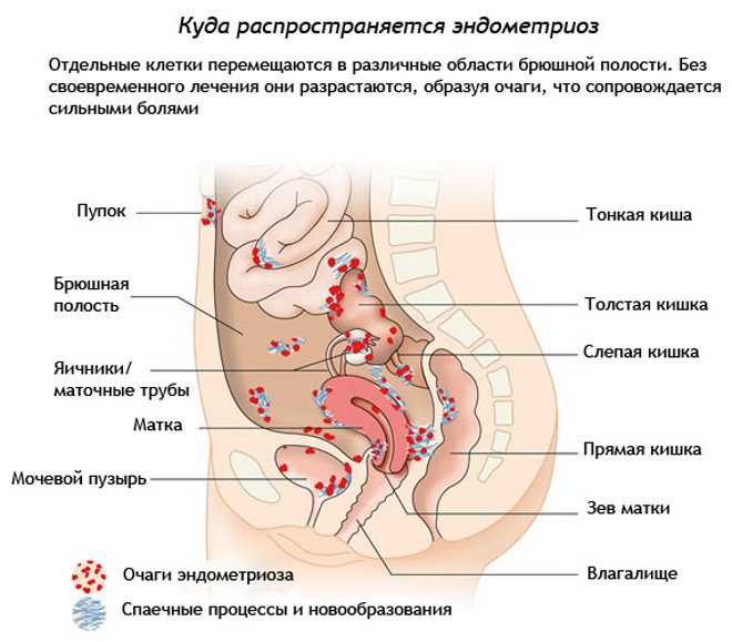 Чем опасен эндометриоз матки