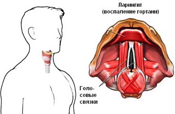 ларингит ларингит