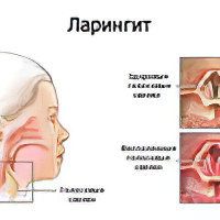 Как вылечить ларингит в домашних условиях у взрослых