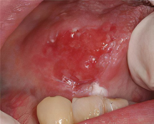 Симптомы лейкоплакии полости рта