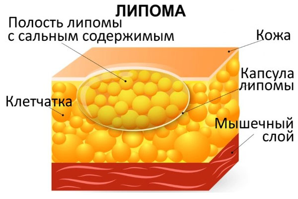 Липома – что это такое и как лечить?