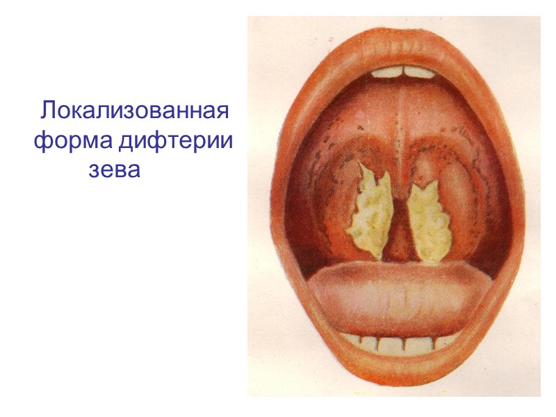 Локализованная дифтерия