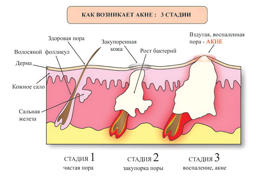 Механизм развития угрей Механизм развития угрей