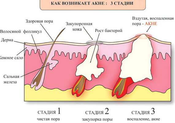 Механизм развития угрей