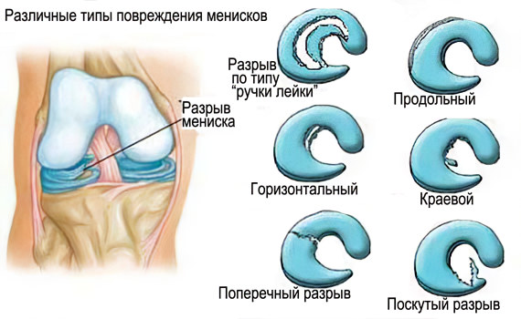 Травма мениска