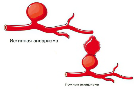 Что представляет собой мешотчатая аневризма