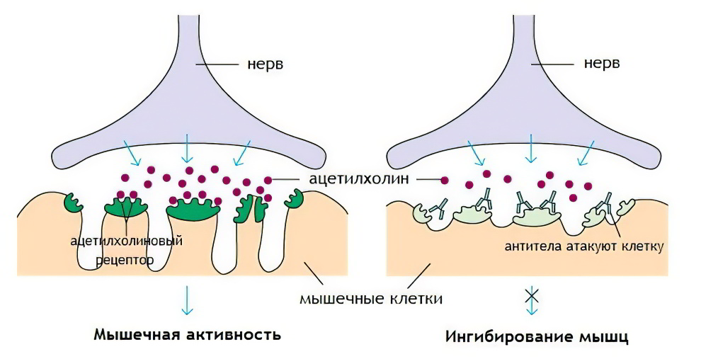 миастения