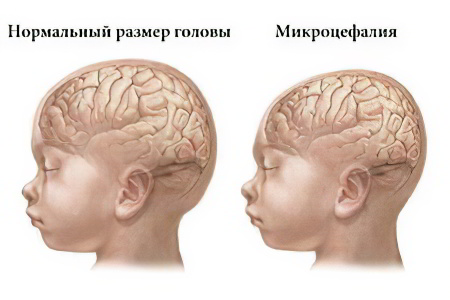 Микроцефалия у детей