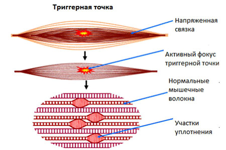 Миофасциальный синдром