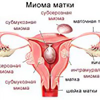 Как вылечить фибромиому народными средствами