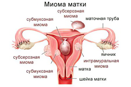 Чем опасна и как лечить миому матки? 