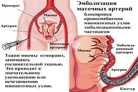 Эмболизация маточных артерий