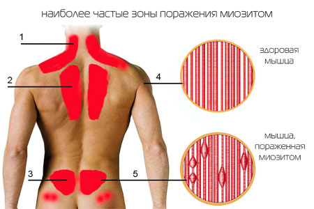 Миозиты спины