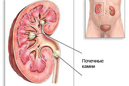 мочекаменная болезнь