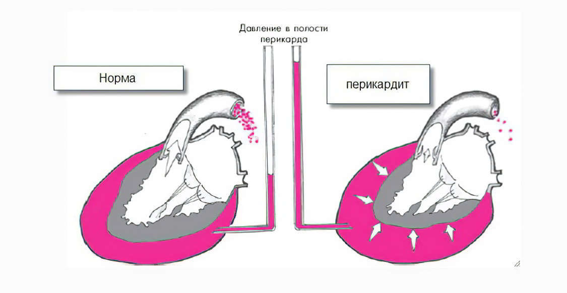 Что происходит в сердце