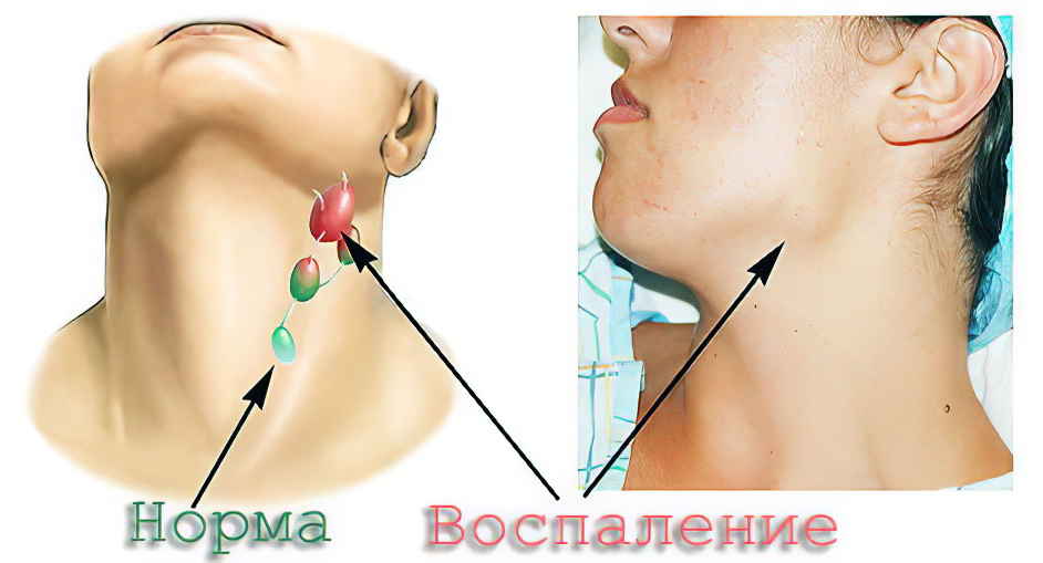 Причиной воспаления лимфоузлов