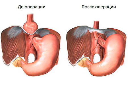 Операция