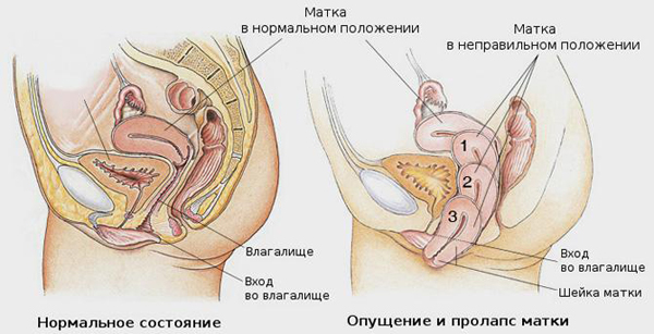 Опущение матки