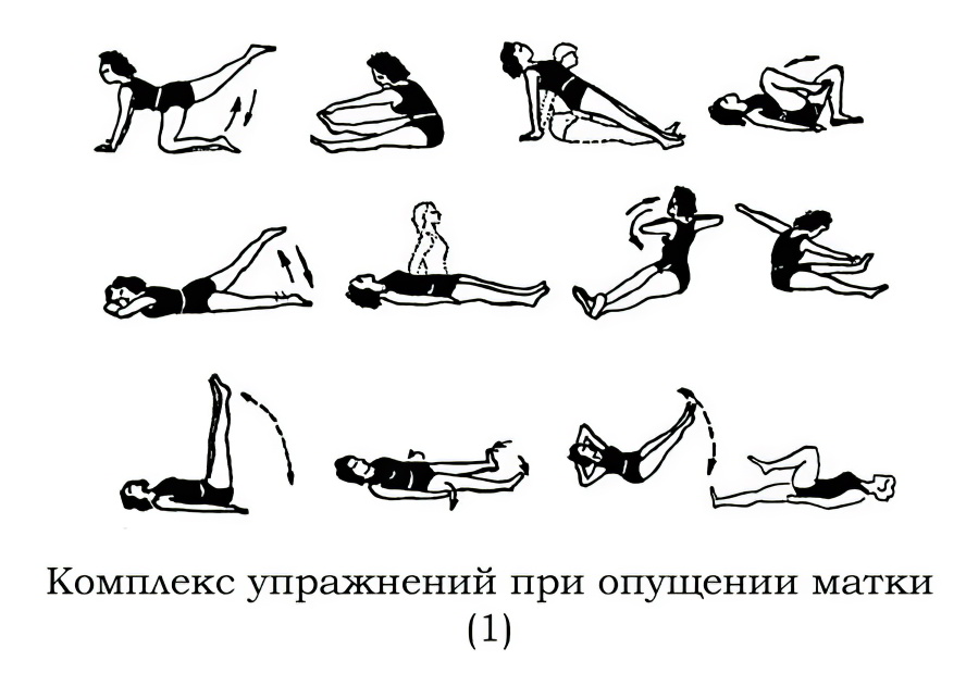 опущения матки упражнения