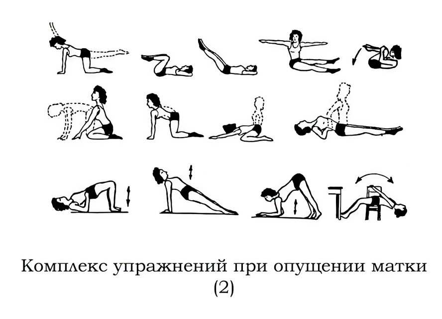 опущения матки упражнения